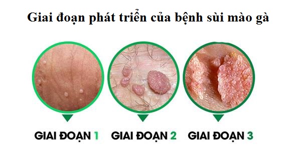 sùi mào gà giai đoạn đầu