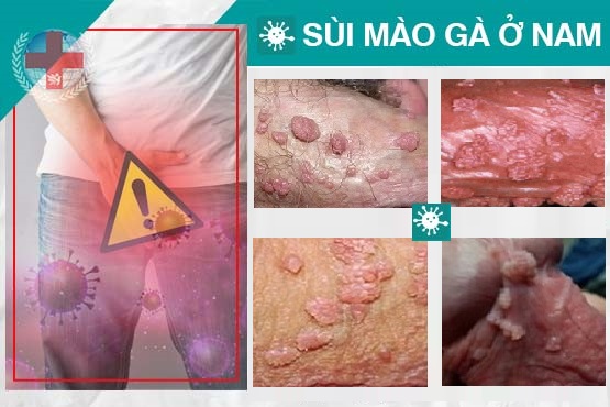 sùi mào gà ở nam